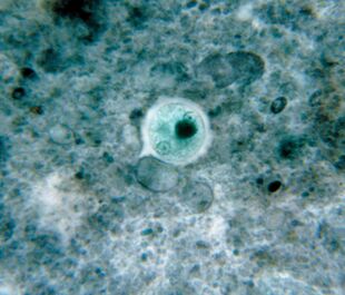 Dizenteria ameba